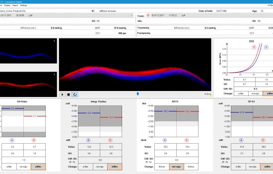 OCULUS Corvis® ST - Biomechanical Comparison Display // Screenshot, EN