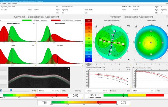OCULUS Corvis® ST - Tomographic Biomechanical Assessment // Screenshot, EN