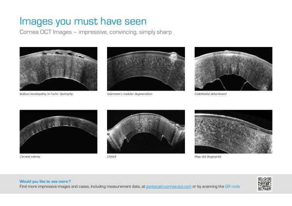 Pentacam® Cornea OCT – Tomógrafo + AS-OCT OCULUS_page-0010