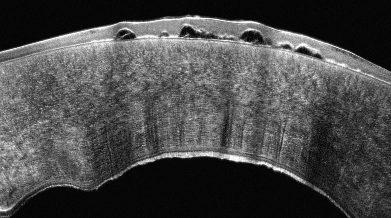 hq4_pentacam_cornea_oct_bullous_keratopathy_in_fuchs_dystrophy